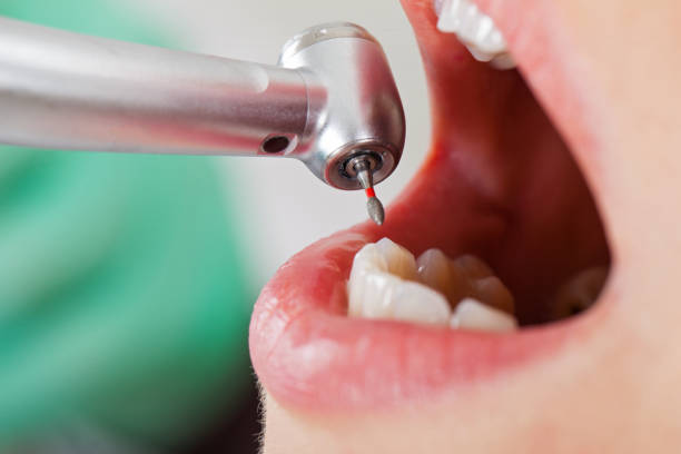 Best Emergency Dentist for Lost Fillings or Crowns in Hollister, MO